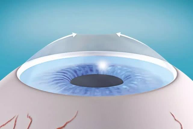 德國阿瑪仕1050Rs千頻Smart全激光設備落戶蘭州普瑞眼視光醫院